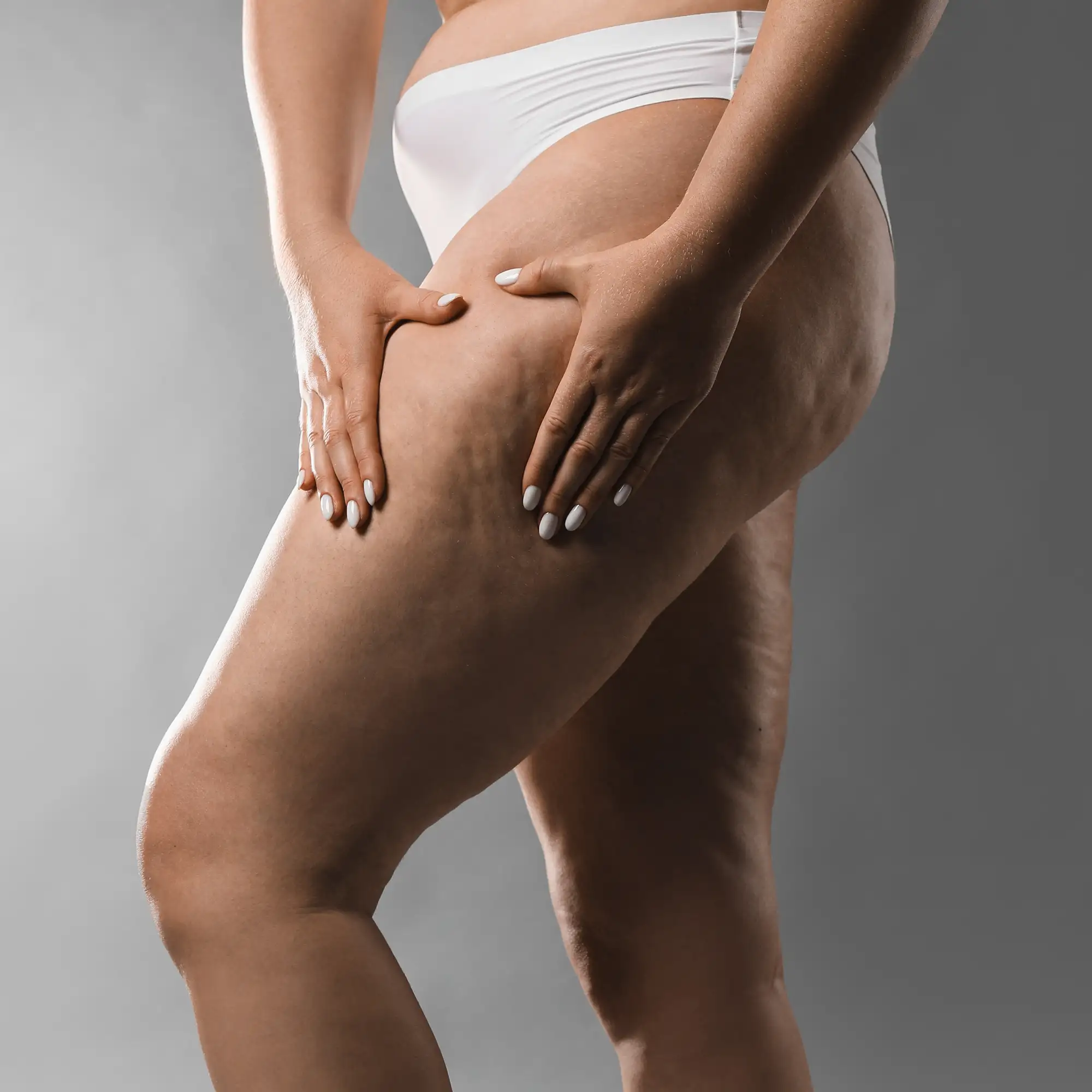 Donna che mostra cellulite su cosce